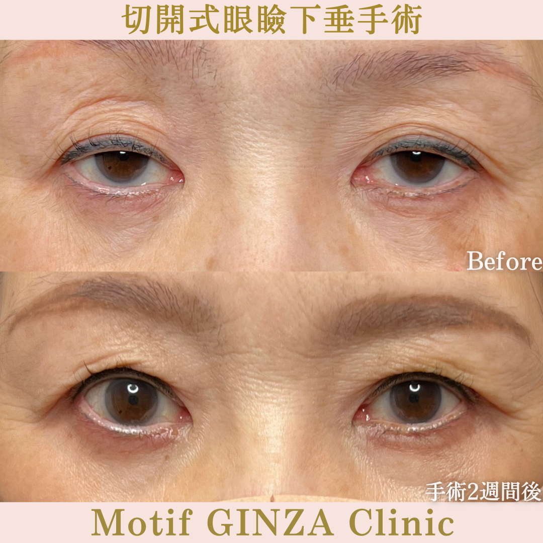 切開式眼瞼下垂手術（手術6か月）の写真5