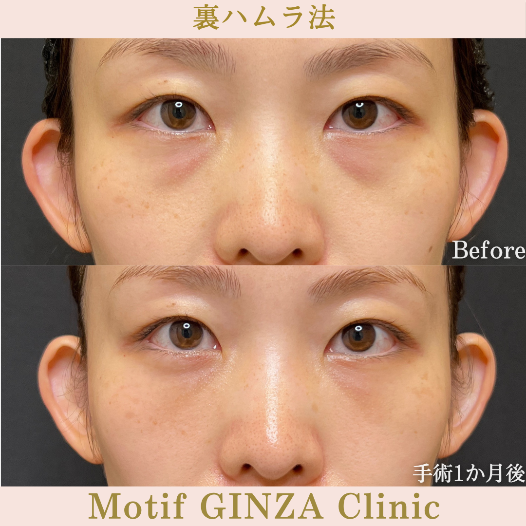 裏ハムラ法(手術3か月)の写真3