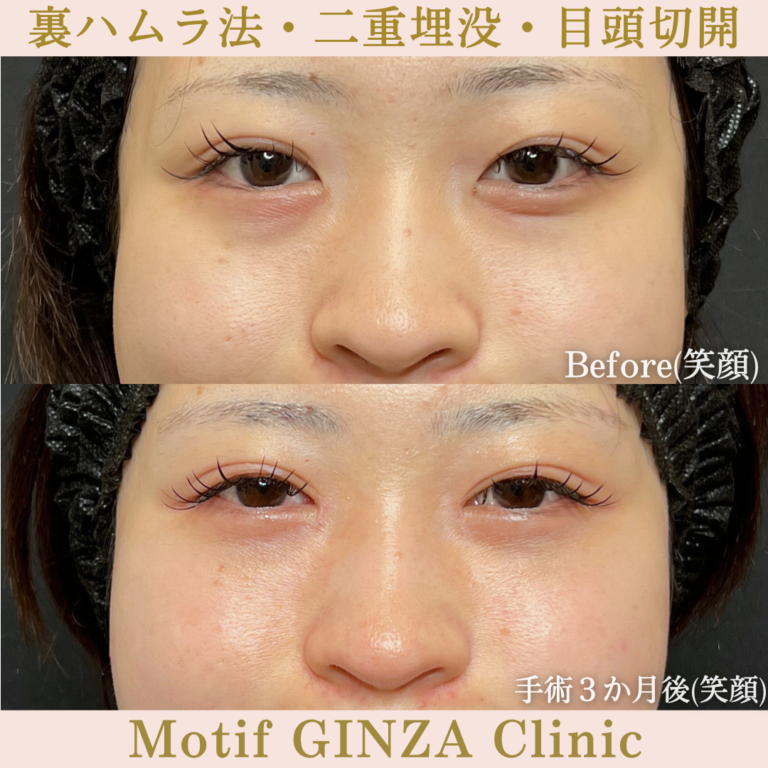 裏ハムラ法・二重埋没法・目頭切開（手術３か月）