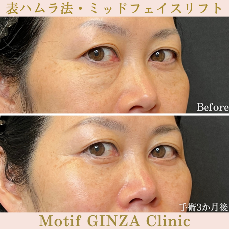 表ハムラ法・ミッドフェイスリフト（手術3か月）の写真2