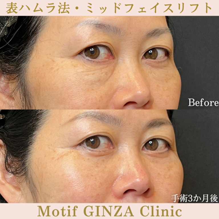 表ハムラ法・ミッドフェイスリフト(手術6か月)の写真4