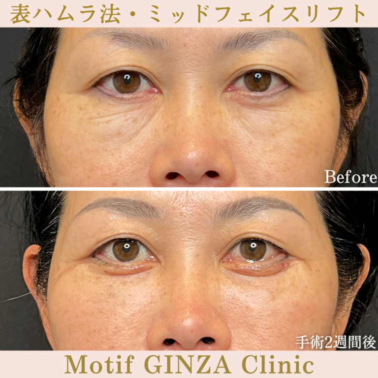 表ハムラ法・ミッドフェイスリフト（手術1か月）の写真3