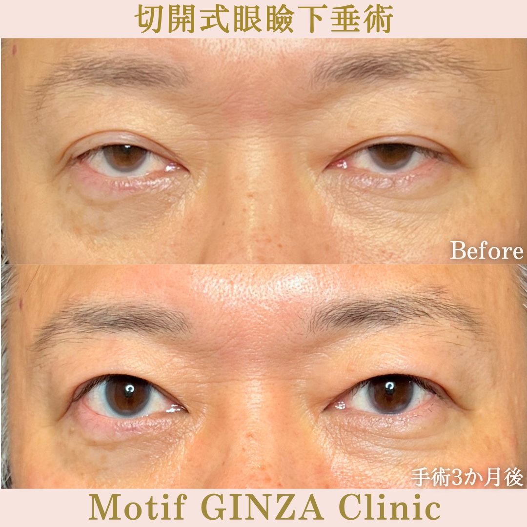 切開式眼瞼下垂手術（手術3か月）の写真