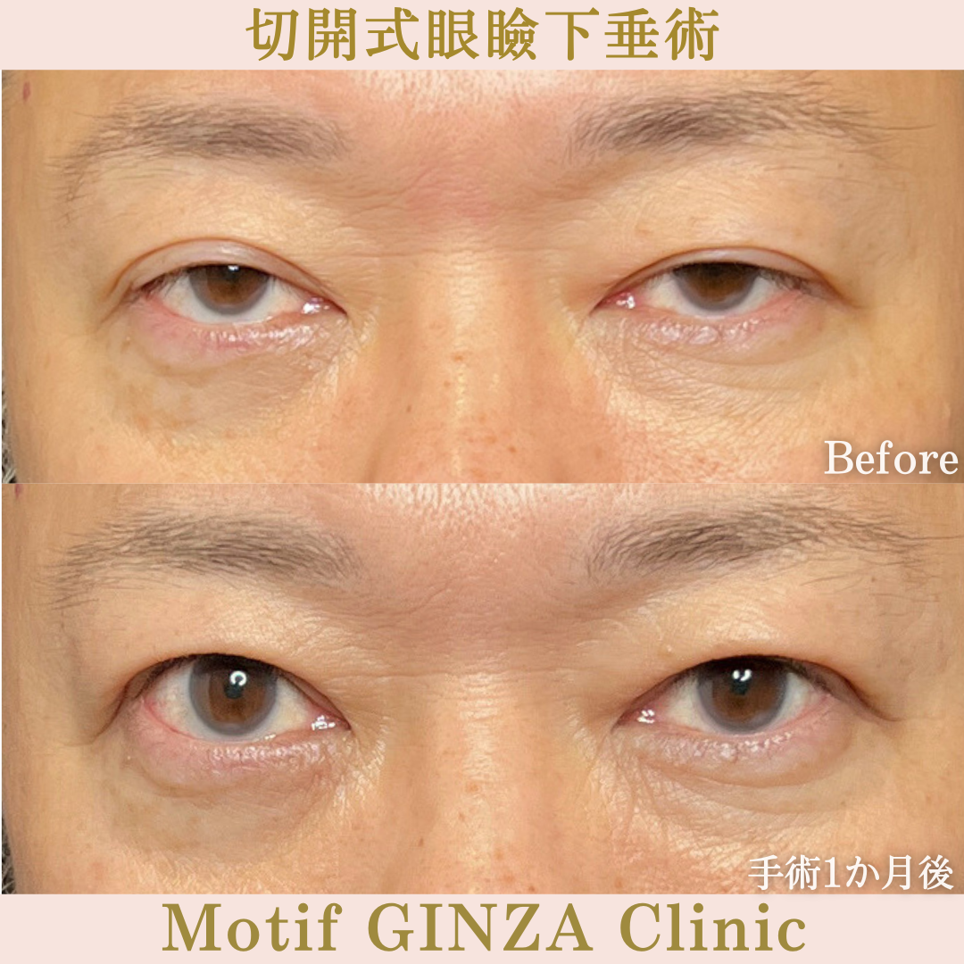 切開式眼瞼下垂手術（手術3か月）の写真3