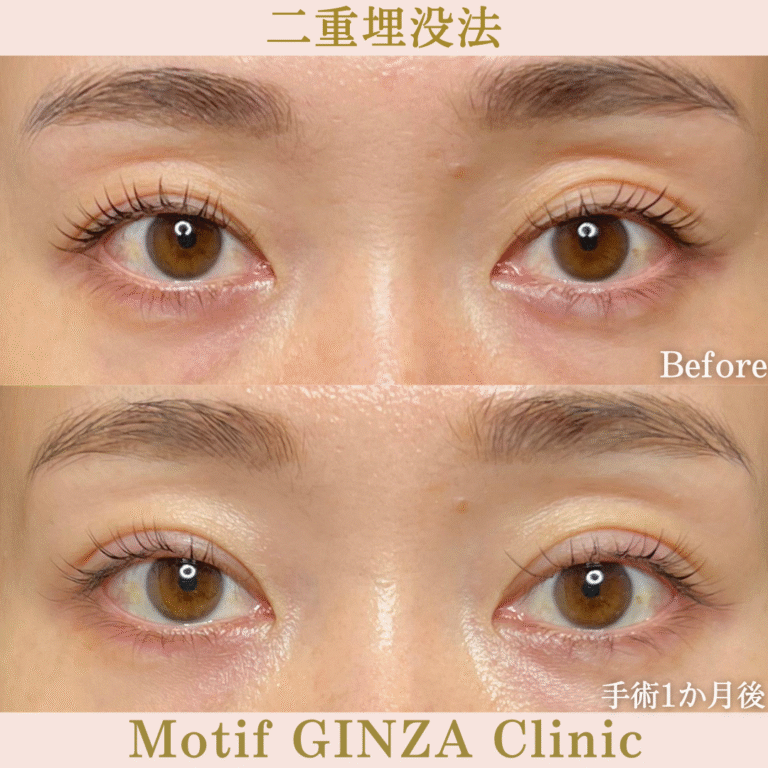 二重埋没法（手術１か月）