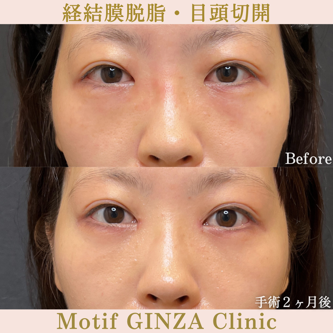経結膜脱脂・目頭切開（手術７ヶ月）の写真5