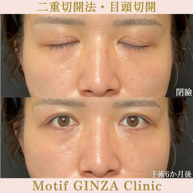 二重切開法・目頭切開(手術6か月)の写真2
