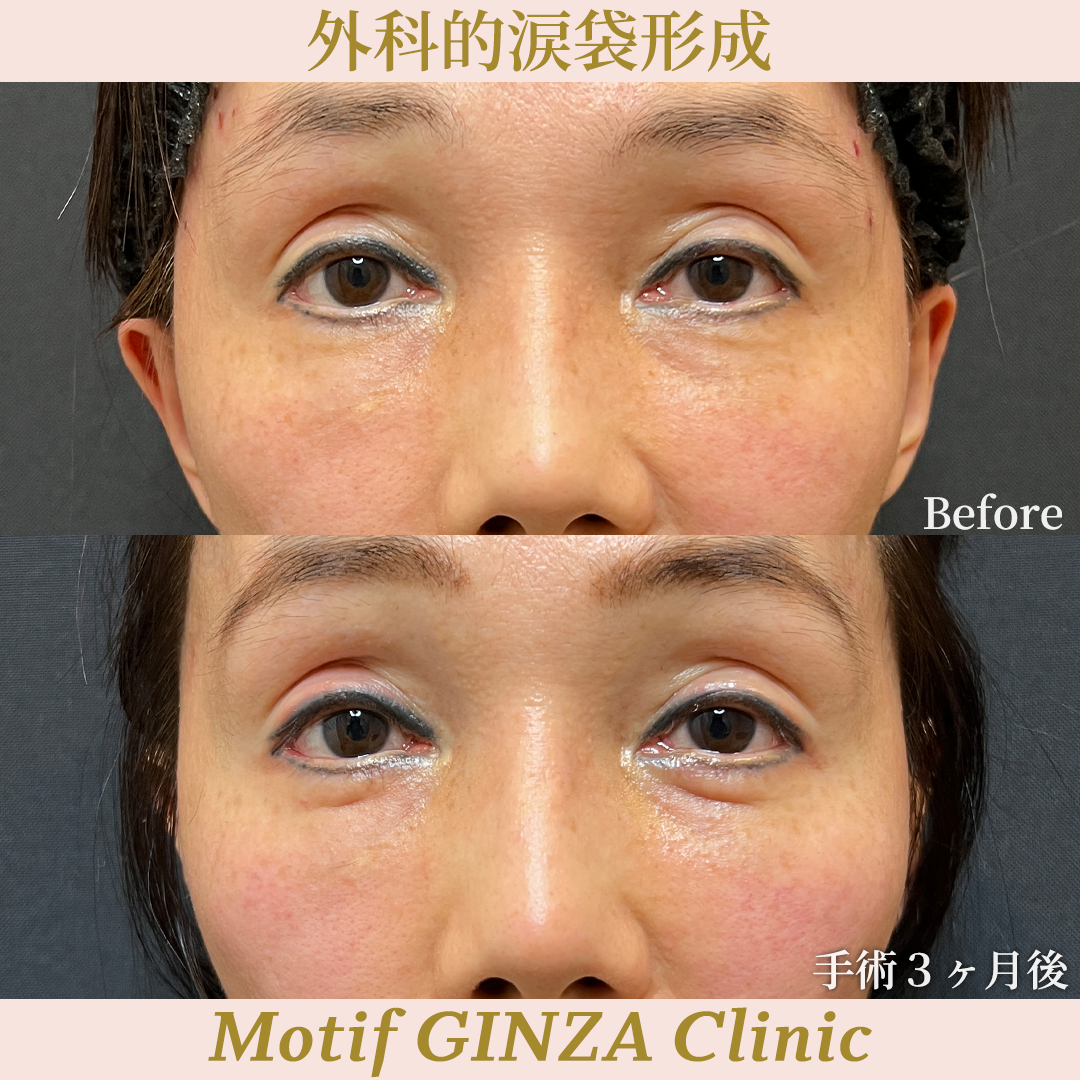 外科的涙袋形成（手術３ヶ月）の写真