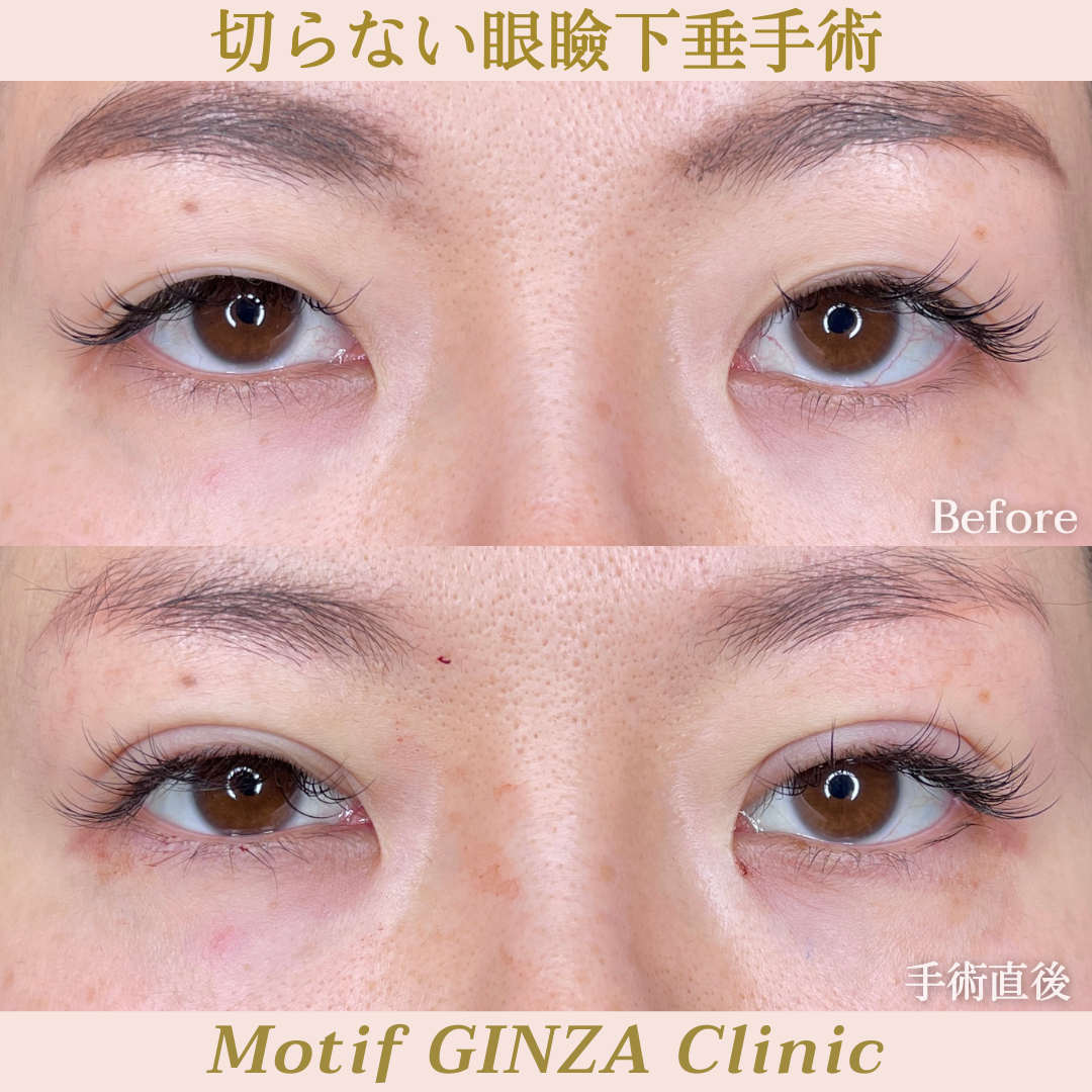 切らない眼瞼下垂手術(手術1週間)の写真2