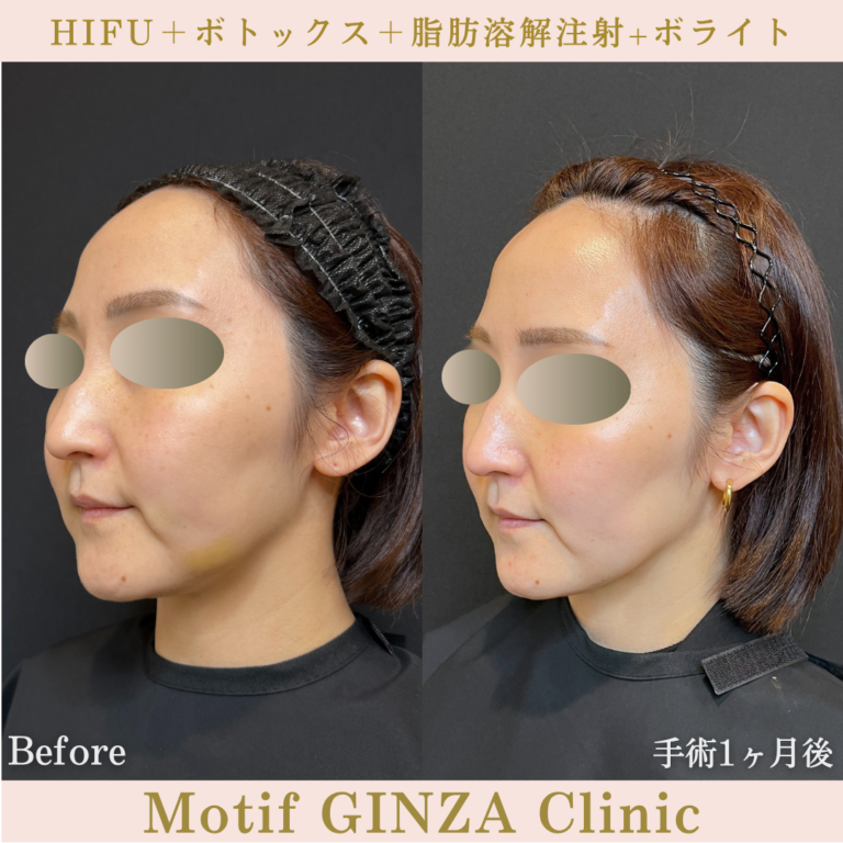 HIFU・ボトックス・脂肪溶解注射・ボライト(手術1ヶ月)の写真2