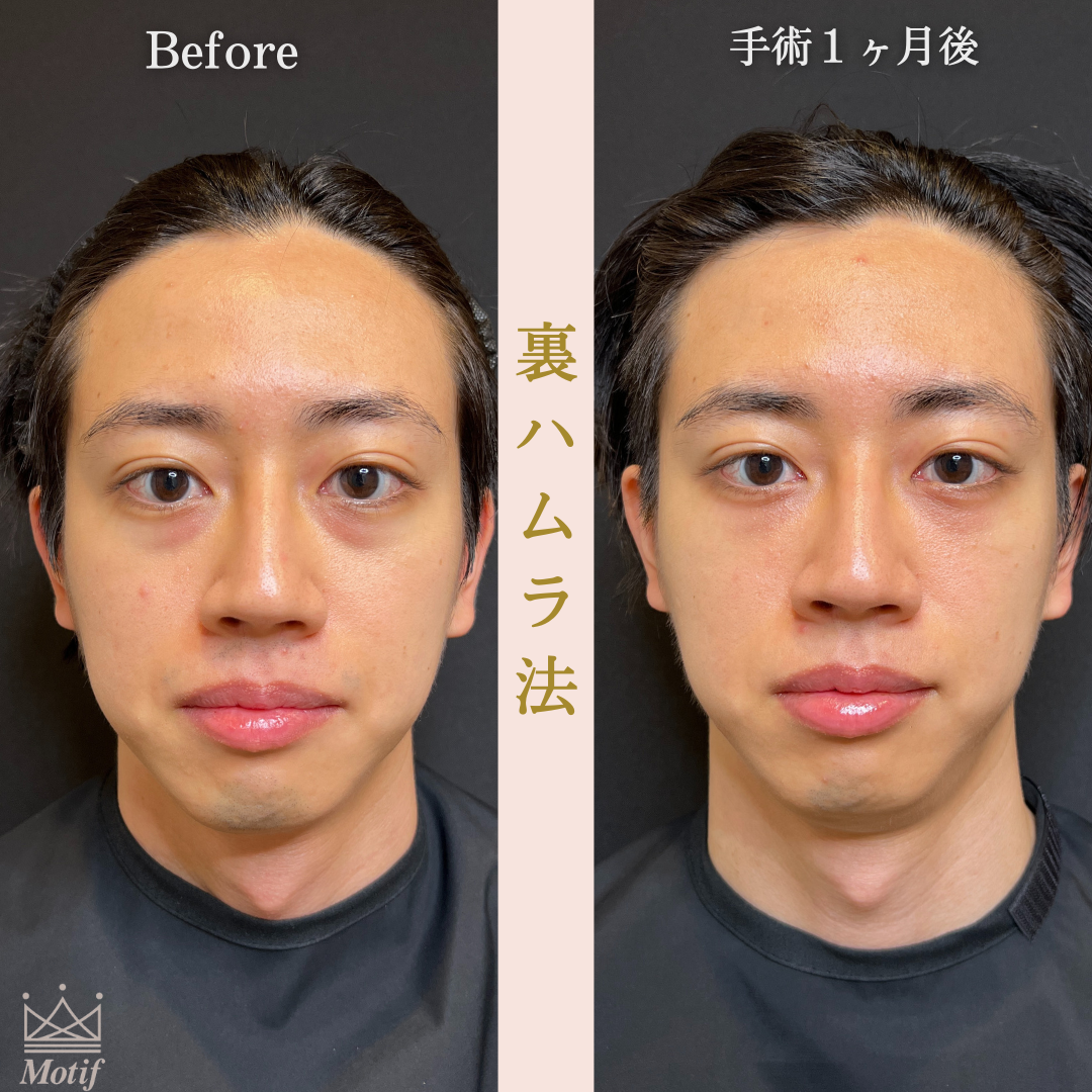 裏ハムラ法（手術３ヶ月）の写真3