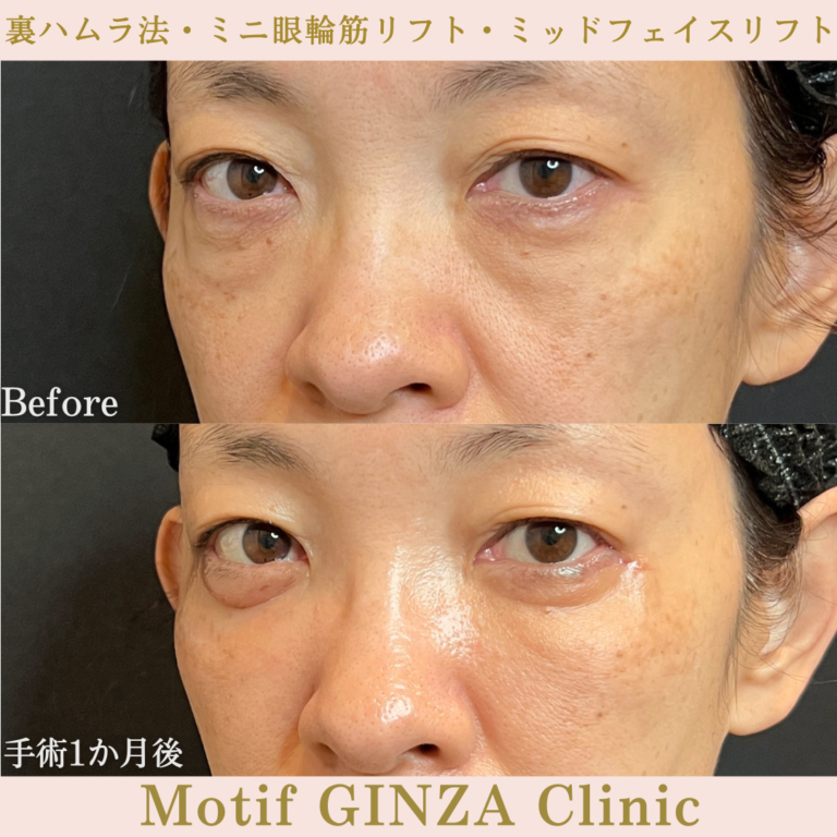 裏ハムラ法・ミニ眼輪筋リフト・ミッドフェイスリフト（手術３か月）の写真4