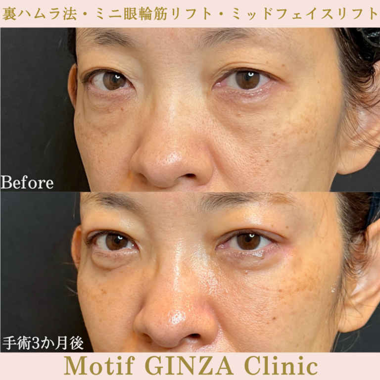 裏ハムラ法・ミニ眼輪筋リフト・ミッドフェイスリフト（手術３か月）の写真2