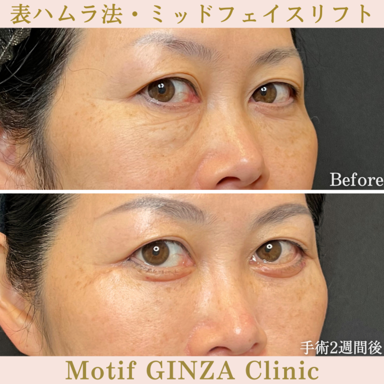 表ハムラ法・ミッドフェイスリフト（手術1か月）の写真4