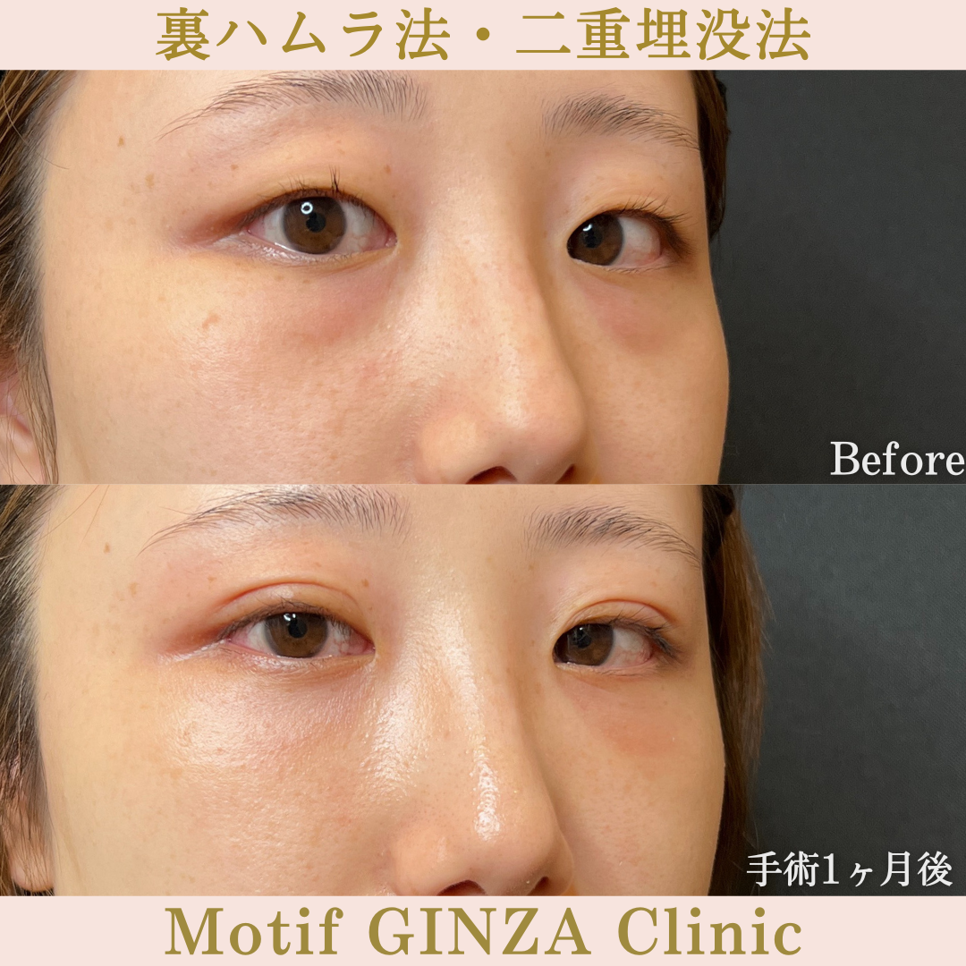 裏ハムラ法・二重埋没法(手術2年3ヶ月)の写真6