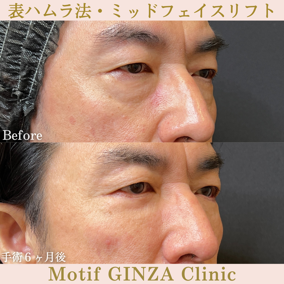 切開式下眼瞼たるみ取り・ミッドフェイスリフト(手術6ヶ月)の写真2