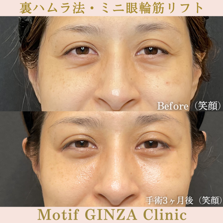 裏ハムラ法・ミニ眼輪筋リフト（手術６か月）の写真4