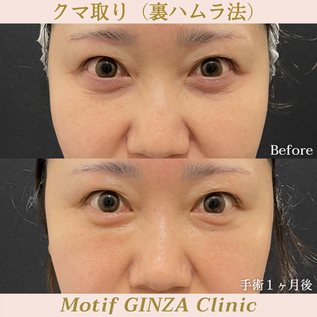 裏ハムラ法(手術3ヶ月)の写真3