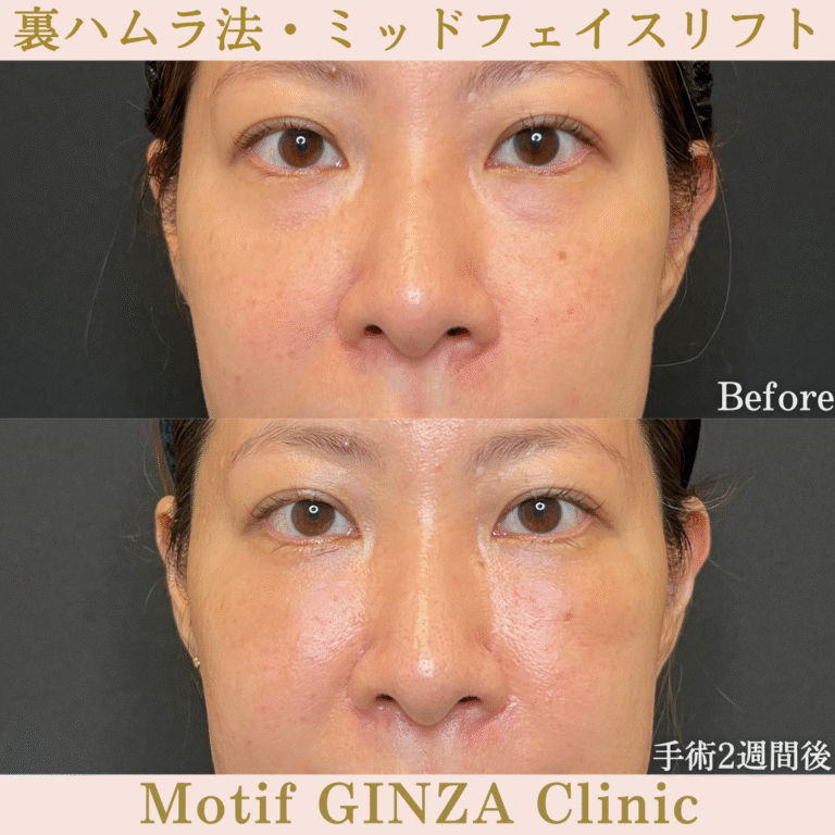 裏ハムラ法・ミッドフェイスリフト（手術３か月）の写真5
