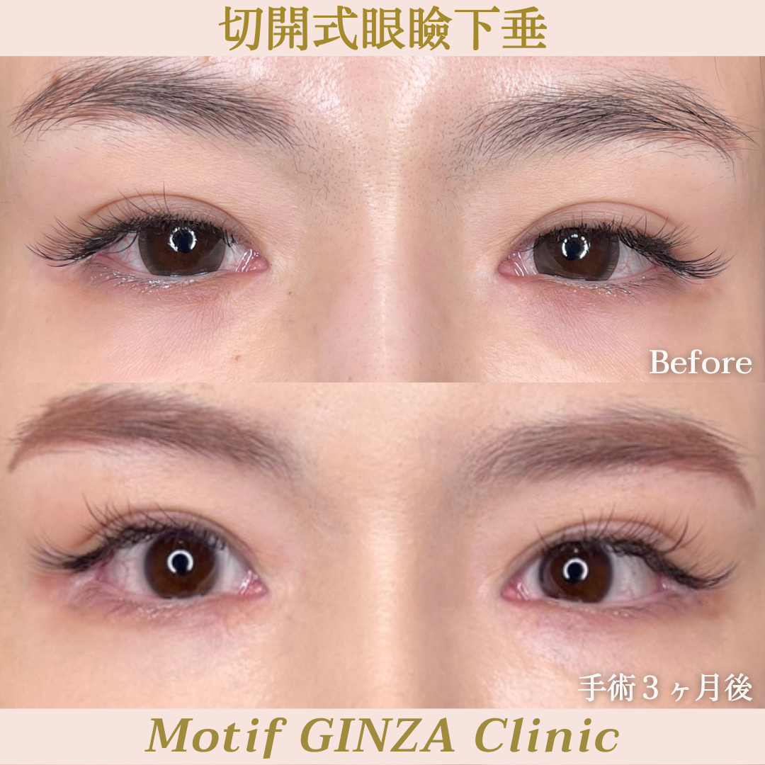 切開式眼瞼下垂手術（手術３ヶ月）の写真