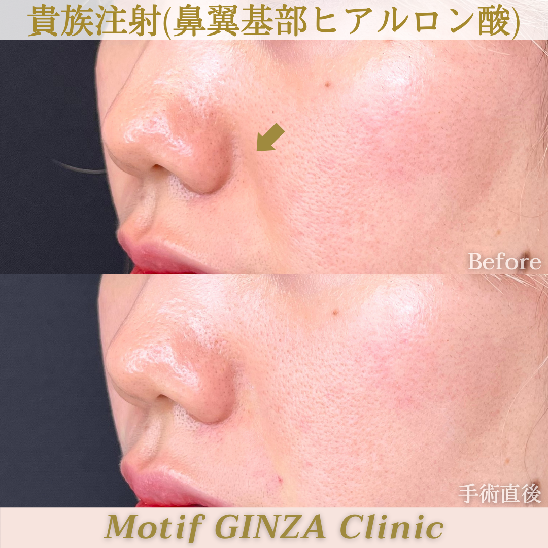 鼻翼基部ヒアルロン酸（手術直後）の写真