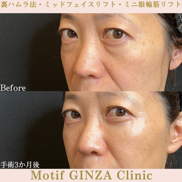 裏ハムラ法・ミッドフェイスリフト・ミニ眼輪筋リフト（手術１か月）の写真2