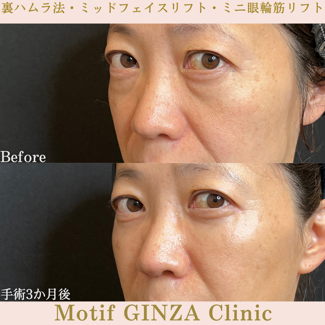 裏ハムラ法・ミッドフェイスリフト・ミニ眼輪筋リフト（手術３か月）の写真4