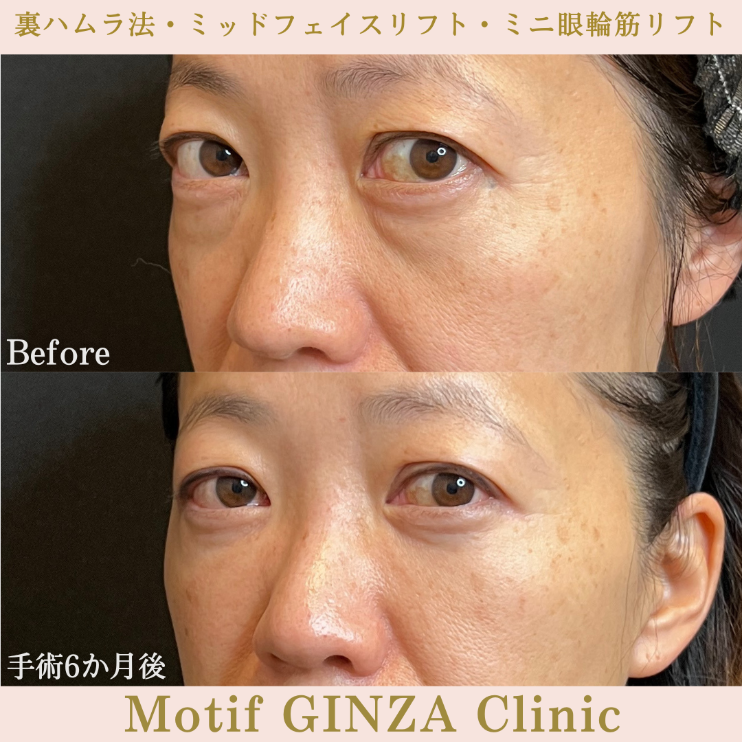 裏ハムラ法・ミッドフェイスリフト・ミニ眼輪筋リフト（手術３か月）の写真2