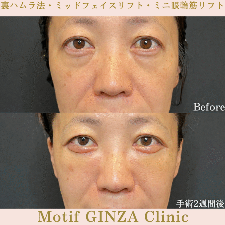 裏ハムラ法・ミッドフェイスリフト・ミニ眼輪筋リフト（手術１か月）の写真4