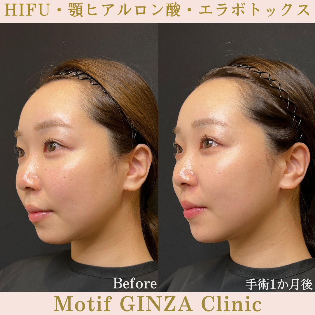 HIFU・顎ヒアルロン酸・エラボトックス（手術１か月）の写真2