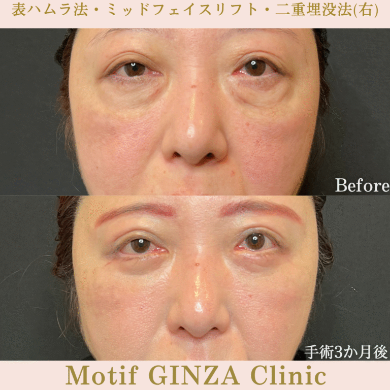 切開式下眼瞼たるみ取り・ミッドフェイスリフト・二重埋没法（手術６か月）の写真3