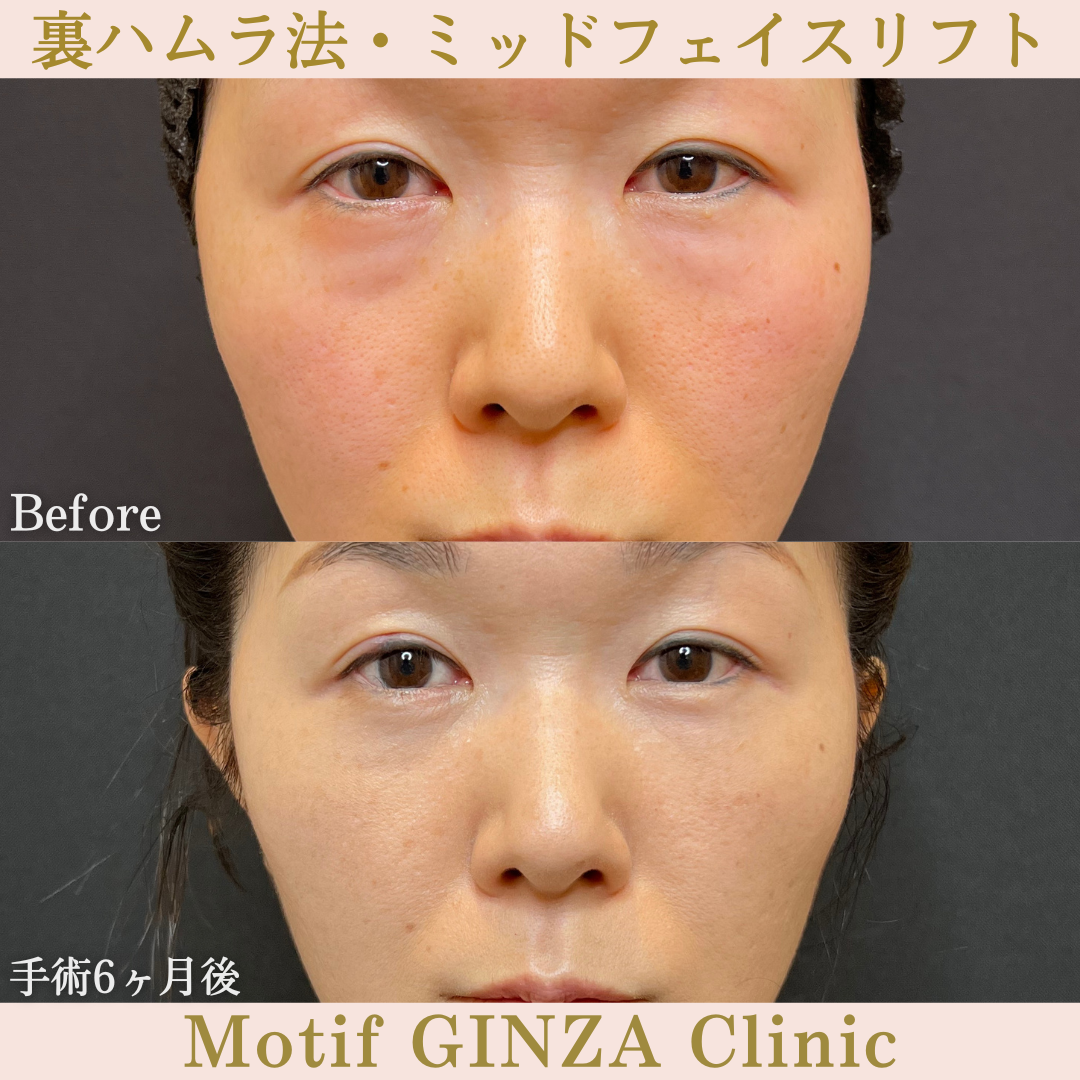 裏ハムラ法・ミッドフェイスリフト（手術６ヶ月）の写真
