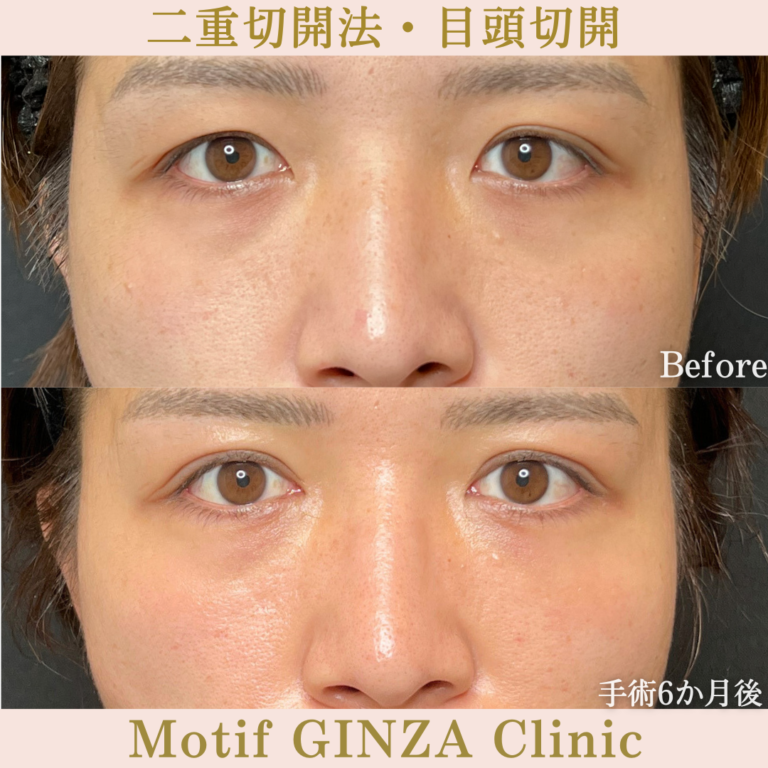 二重切開法・目頭切開（手術6か月）