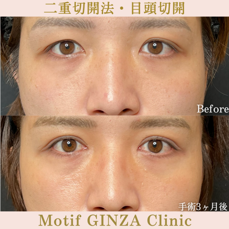 二重切開法・目頭切開（手術３か月）