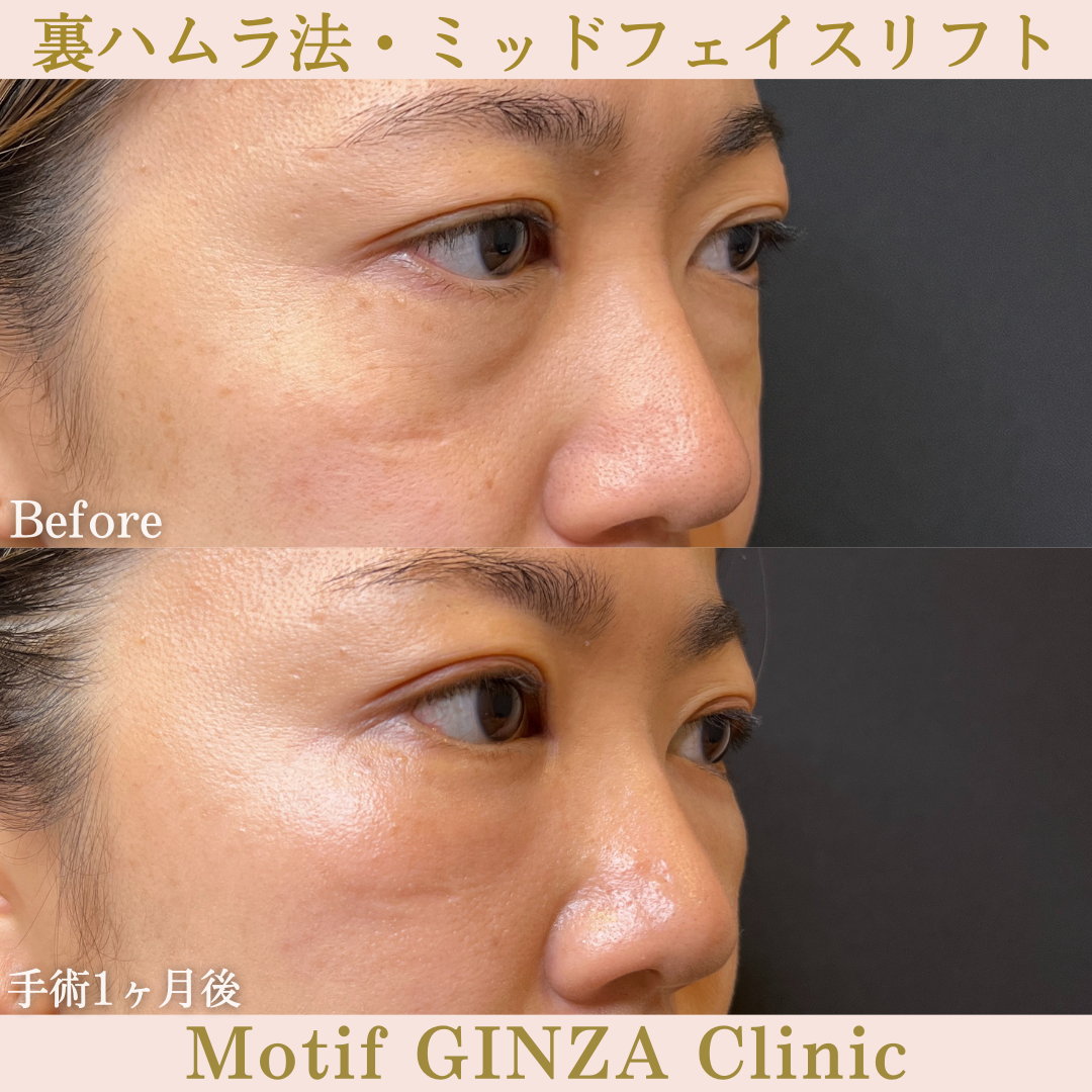 裏ハムラ法・ミッドフェイスリフト（手術１年１ヶ月）の写真4