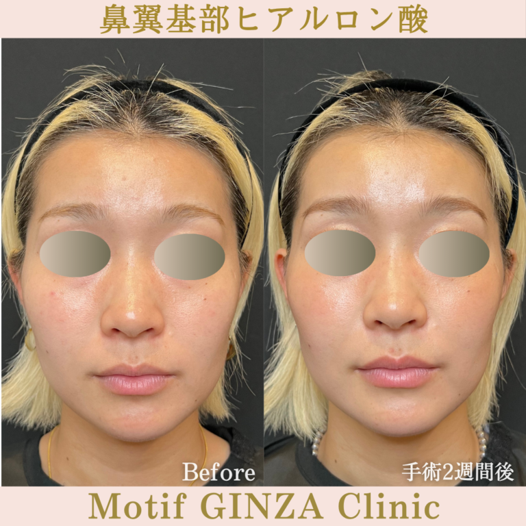 鼻翼基部ヒアルロン酸（手術２週間）の写真2