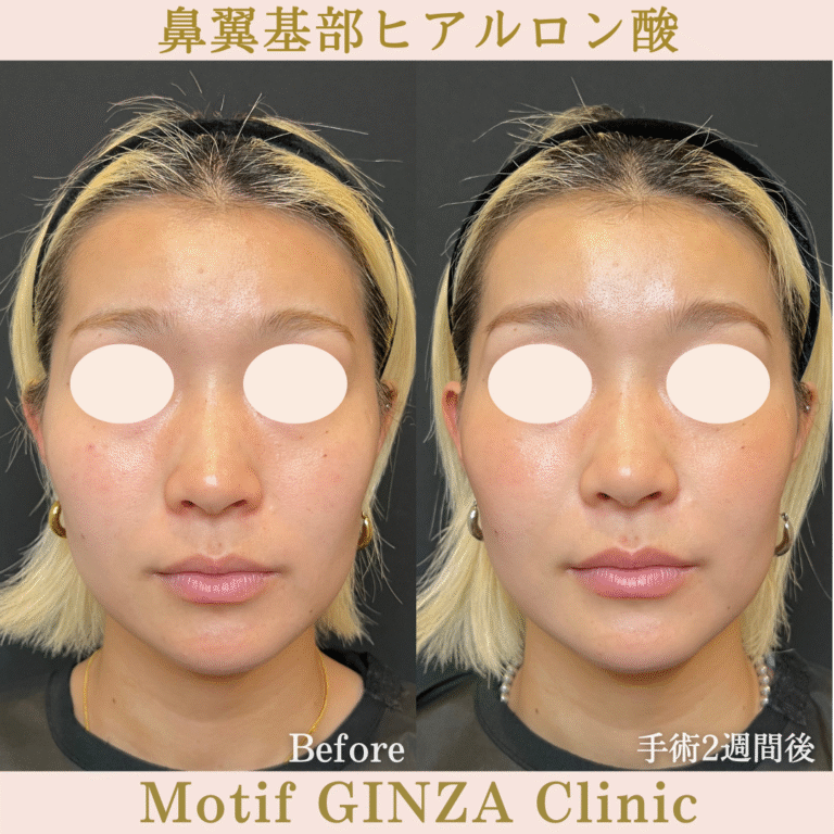 鼻翼基部ヒアルロン酸（手術２週間）の写真2