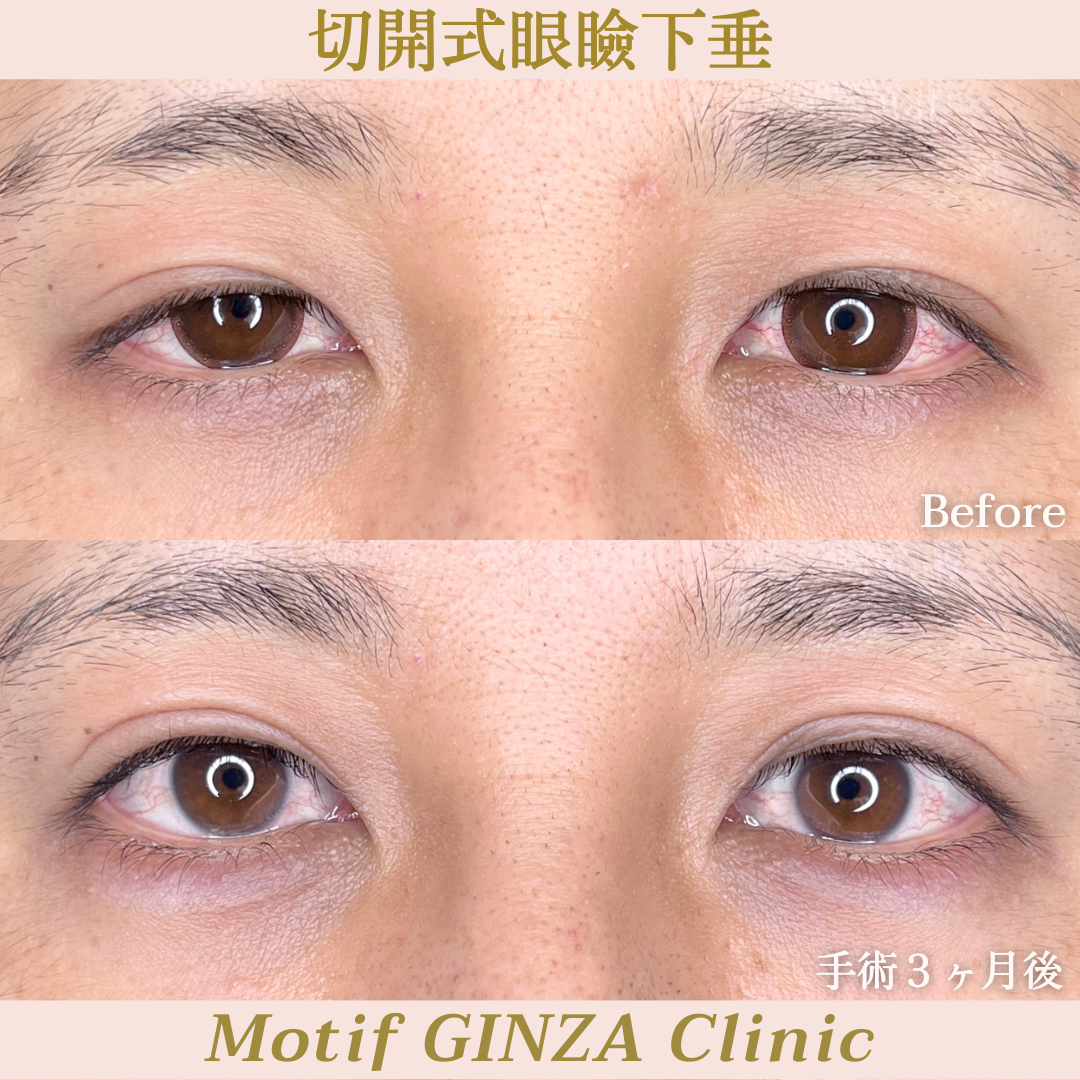 切開式眼瞼下垂手術（手術３ヶ月）の写真