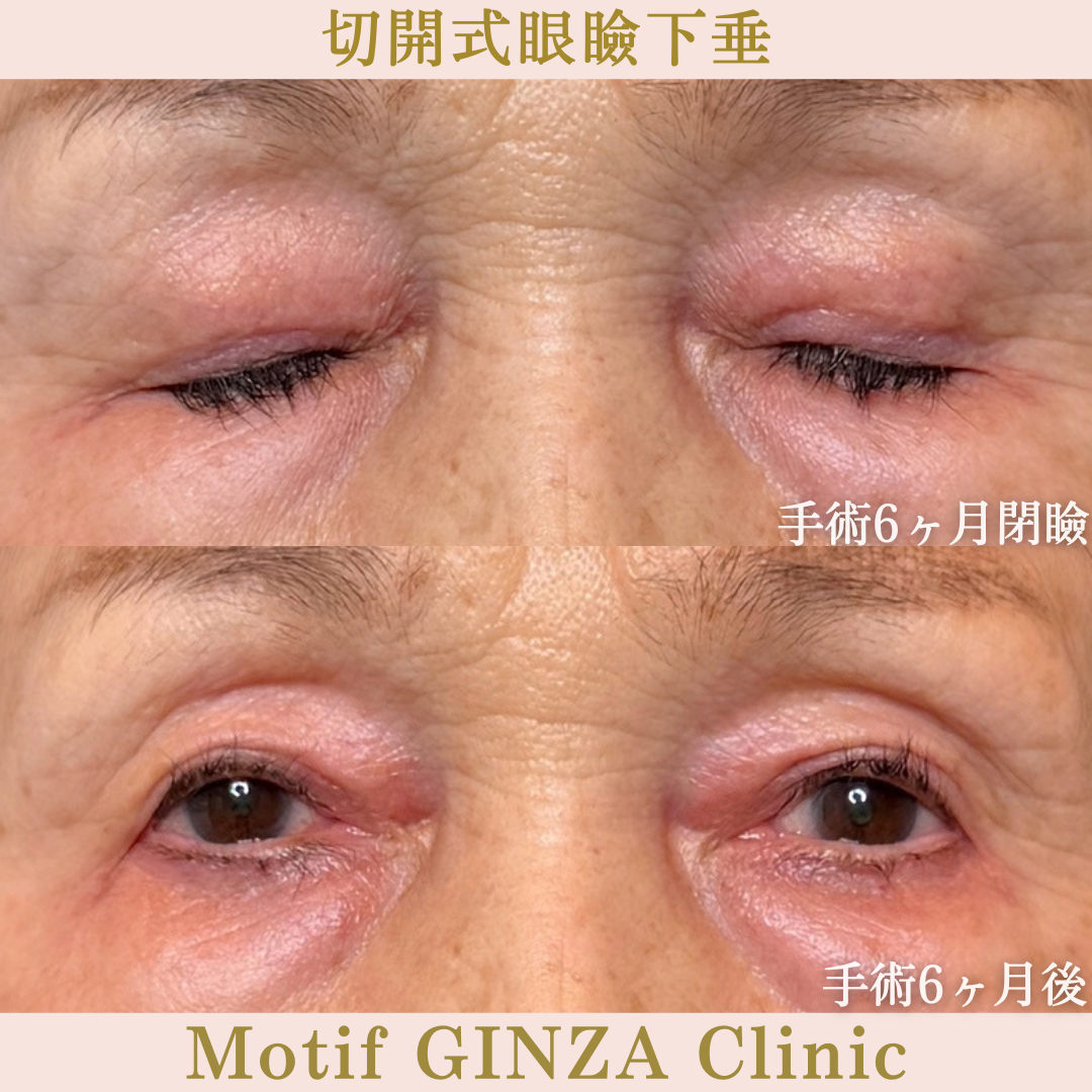 切開式眼瞼下垂手術(手術6か月)の写真2