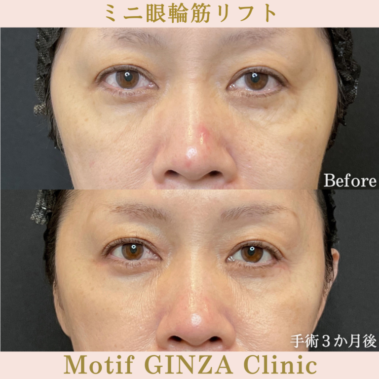 ミニ眼輪筋リフト（手術３か月）