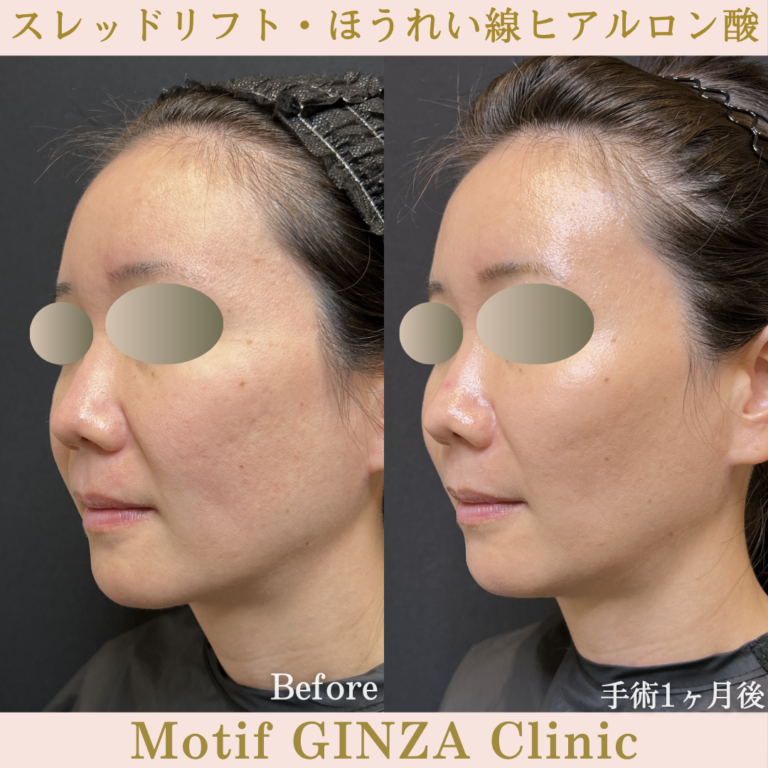 スレッドリフト・ほうれい線ヒアル（手術１ヶ月）の写真2