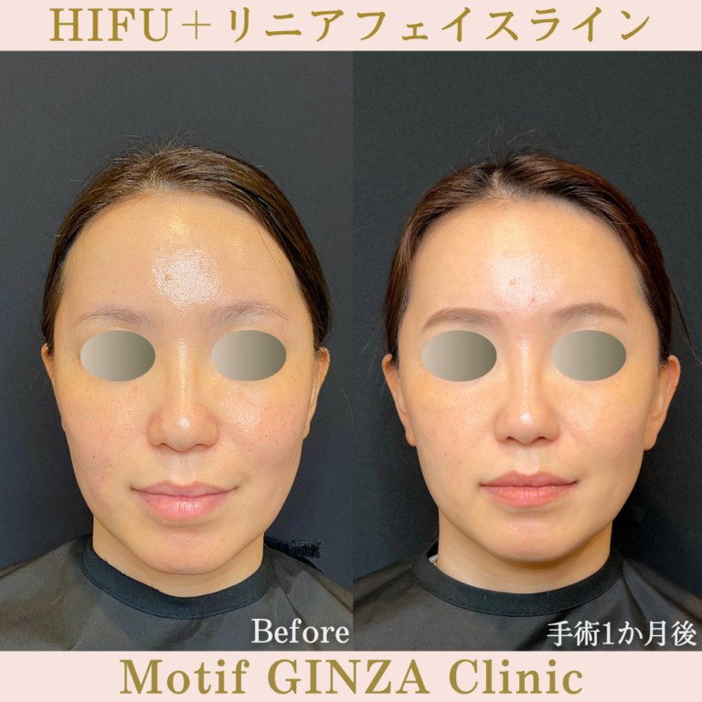HIFU両頬・リニアフェイスライン（手術１か月）