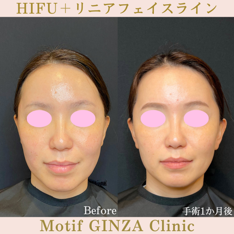 HIFU両頬・リニアフェイスライン（手術１か月）