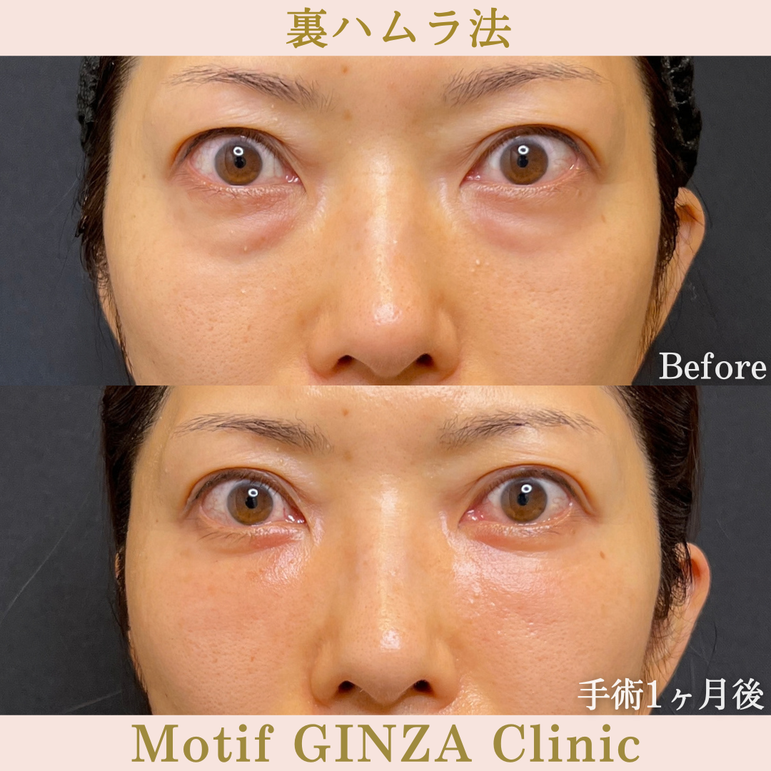 裏ハムラ法（手術7か月）の写真5