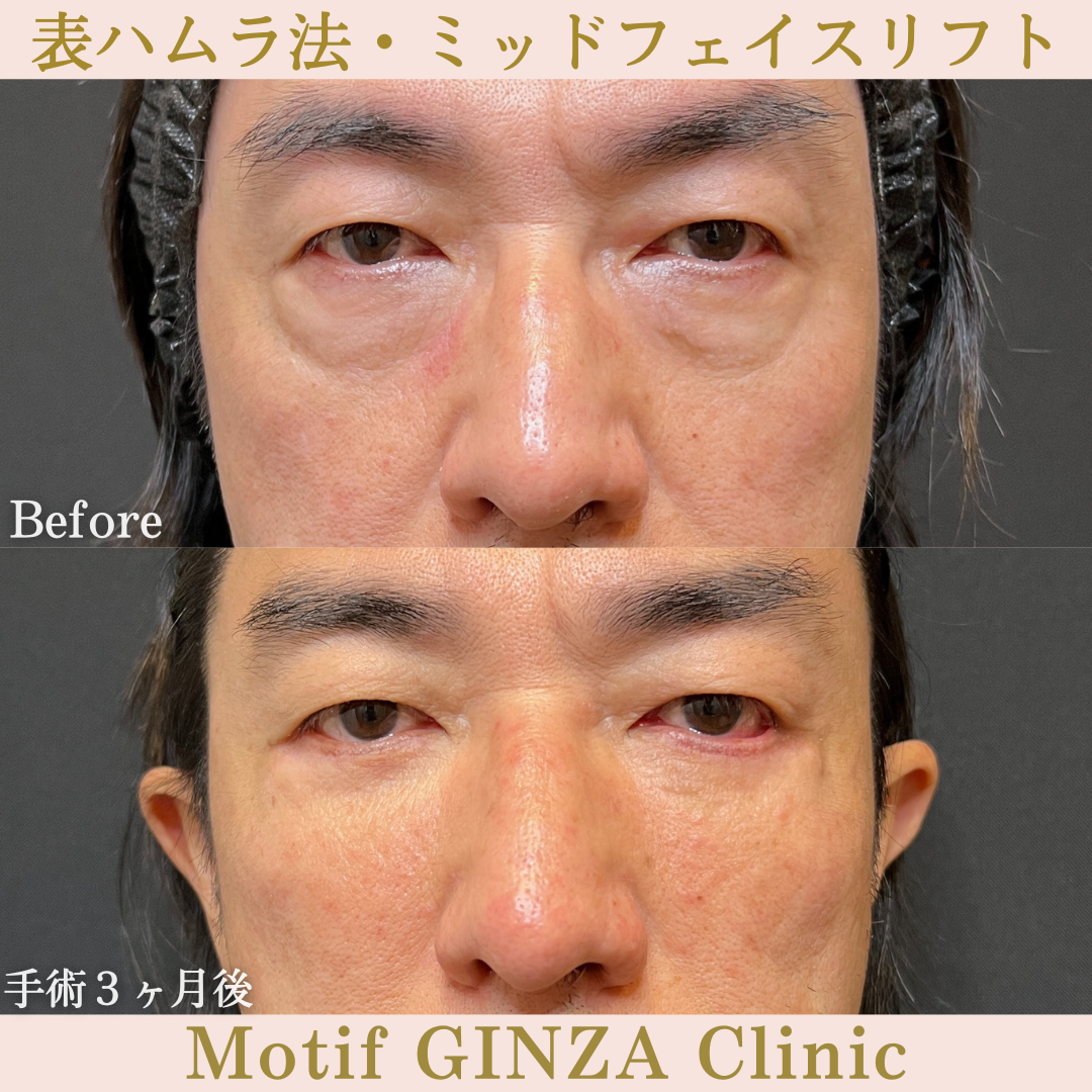 切開式下眼瞼たるみ取り・ミッドフェイスリフト(手術6ヶ月)の写真3