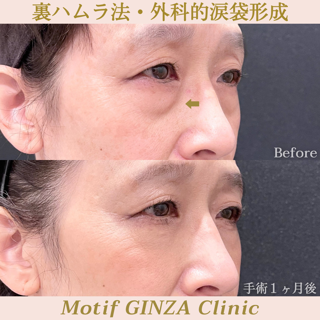 裏ハムラ法・外科的涙袋形成(手術1ヶ月)の写真2