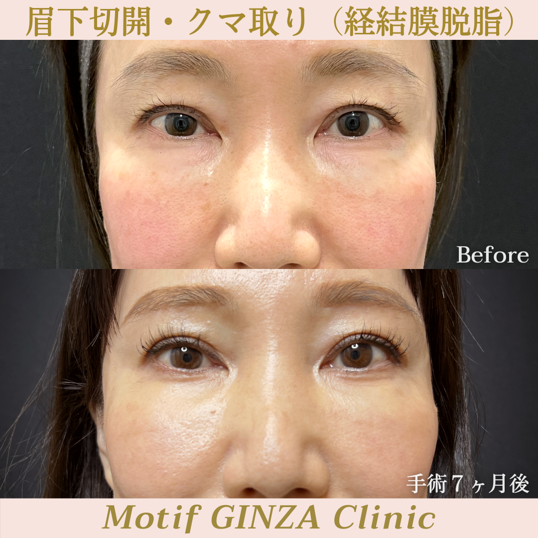 眉下切開・経結膜脱脂（手術７ヶ月）の写真