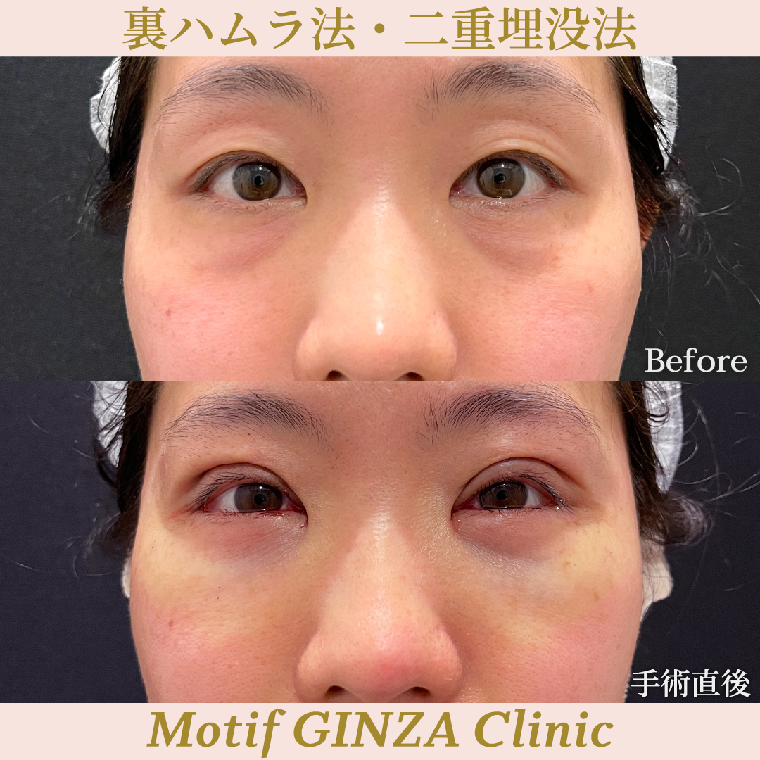 裏ハムラ法・二重埋没法（手術１ヶ月）の写真4