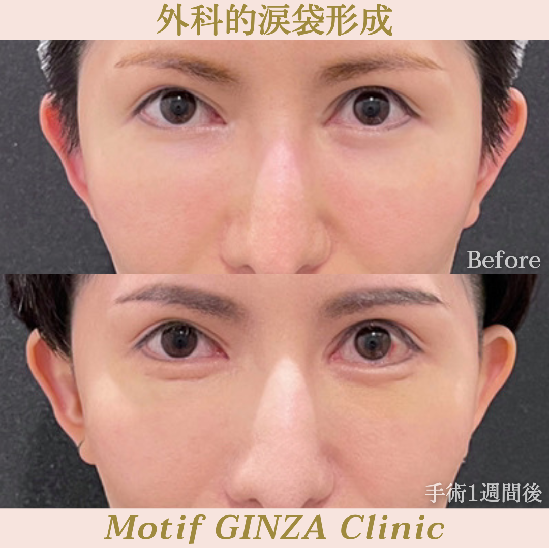 外科的涙袋形成(手術3ヶ月)の写真5