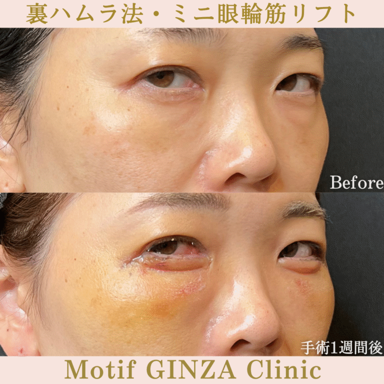 裏ハムラ法・ミニ眼輪筋リフト（手術１か月）の写真6